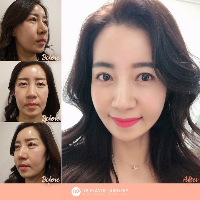 韓国da美容外科 皮膚科 Daprsjp お問い合わせは Line Id Daprsjp 無料オンラインカウンセリング実施中 韓国整形 韓国ビューティークリニック 韓国整形 Da整形外科 韓国旅行 カンナム 糸リフテイング 中年整形 たるみ改善 弾力アップ 美容 韓国da美容外科 皮膚科 Daprsjp お問い合わせは Line Id Daprsjp 無料オンラインカウンセリング実施中 韓国整形 韓国ビューティークリニック 韓国整形 Da整形外科 韓国旅行 カンナム 糸リフテイング 中年整形 たるみ改善 弾力アップ 美容